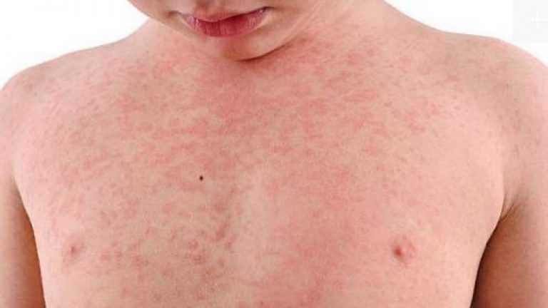 Suben a 4 los casos confirmados de sarampión en familia estadounidense antivacunas