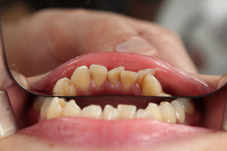 Los motivos claves para seguir o no seguir un tratamiento periodontal
