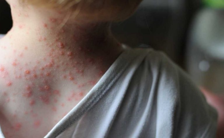OMS sigue de cerca casos de viruela del mono y teme riesgo de trasmisión en Nigeria