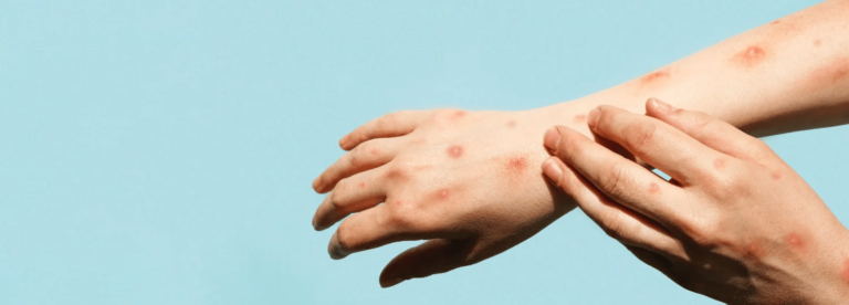 CNVE acuerda no adquirir vacunas contra la viruela símica por el momento