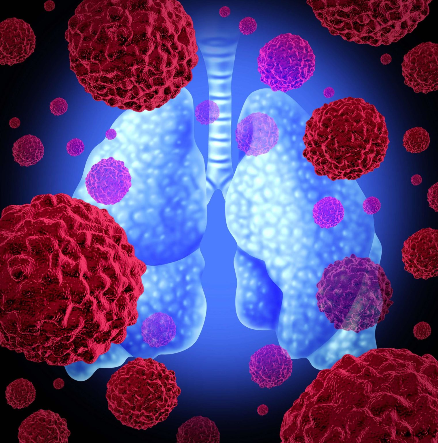 Imagen principal del artículo: 60% de los pacientes con cáncer de pulmón avanzado ALK positivo viven más de cinco años sin progresión de la enfermedad