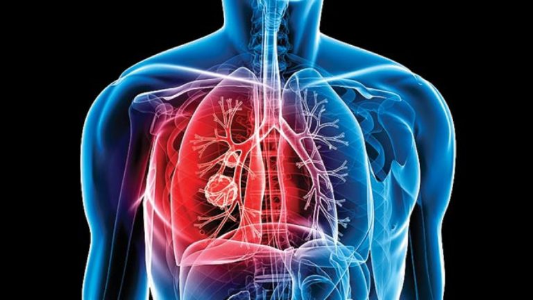 Ministerio de Salud confirma tres casos de Tuberculosis en San Carlos