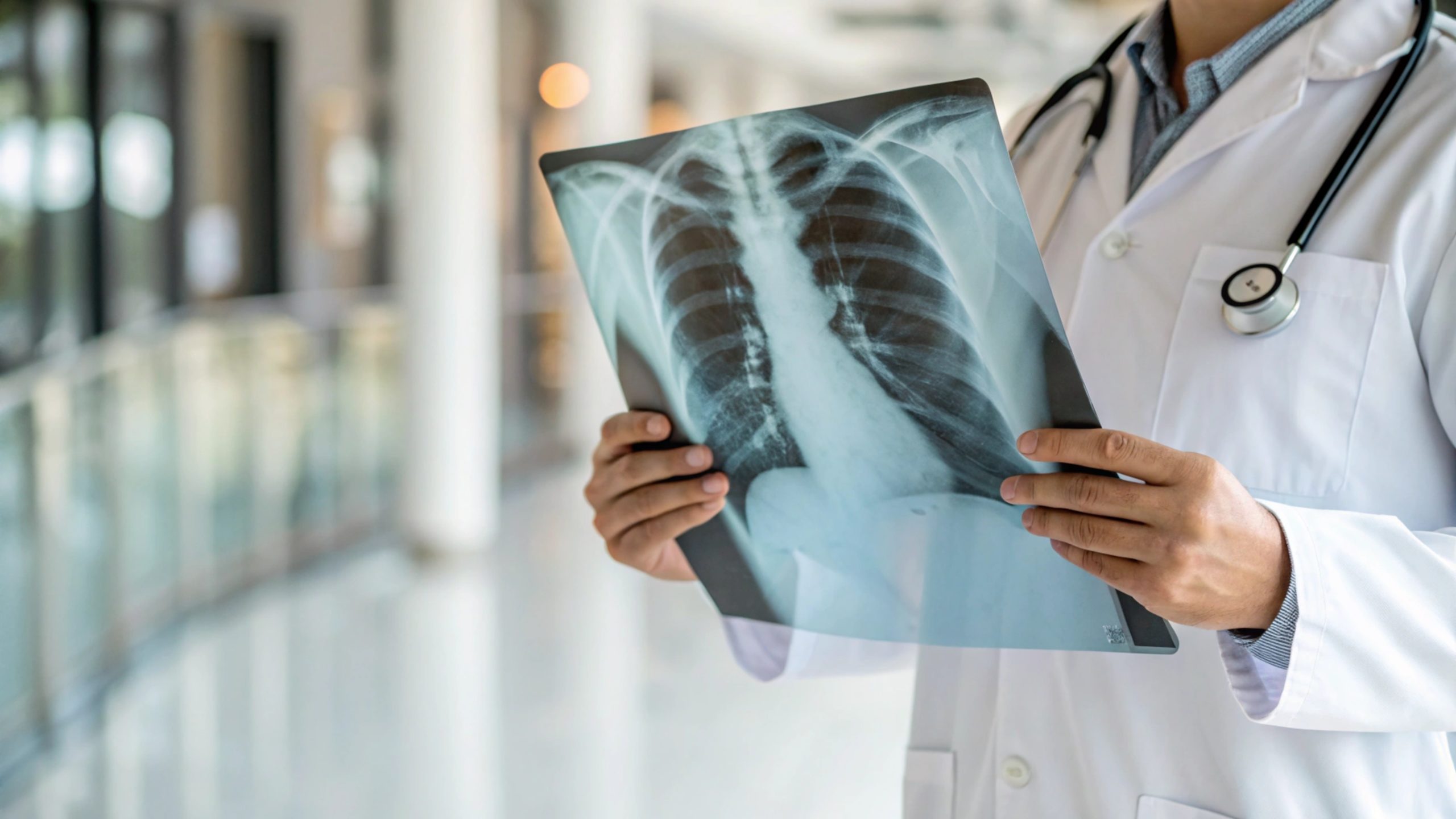 Imagen principal del artículo: Rompiendo mitos y generando conciencia sobre el cáncer de pulmón